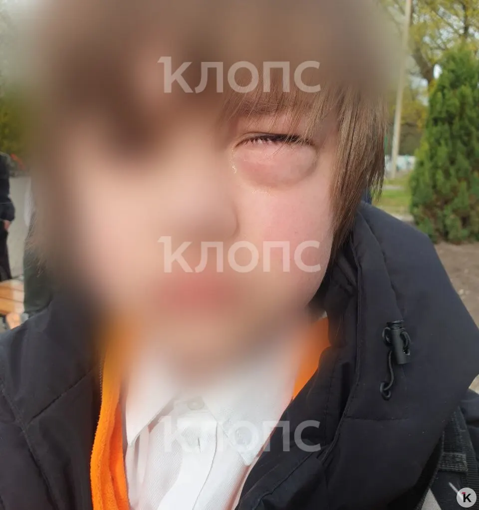 Мальчик получил перелом глазницы — мама говорит, что урок продолжался, пока его глаз распух, и только позже потребовалась операция.